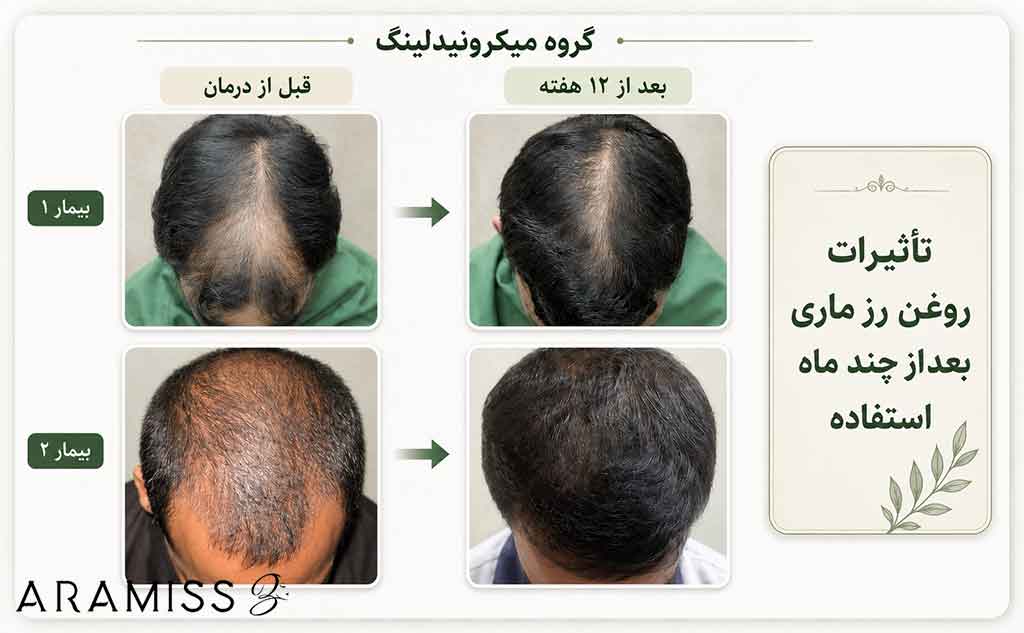 استفاده قبل و بعد از روغن رزماری