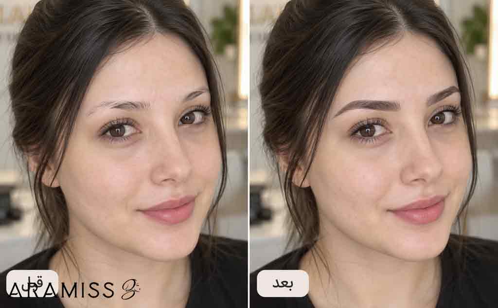 قبل و بعد از فیبروز ابرو